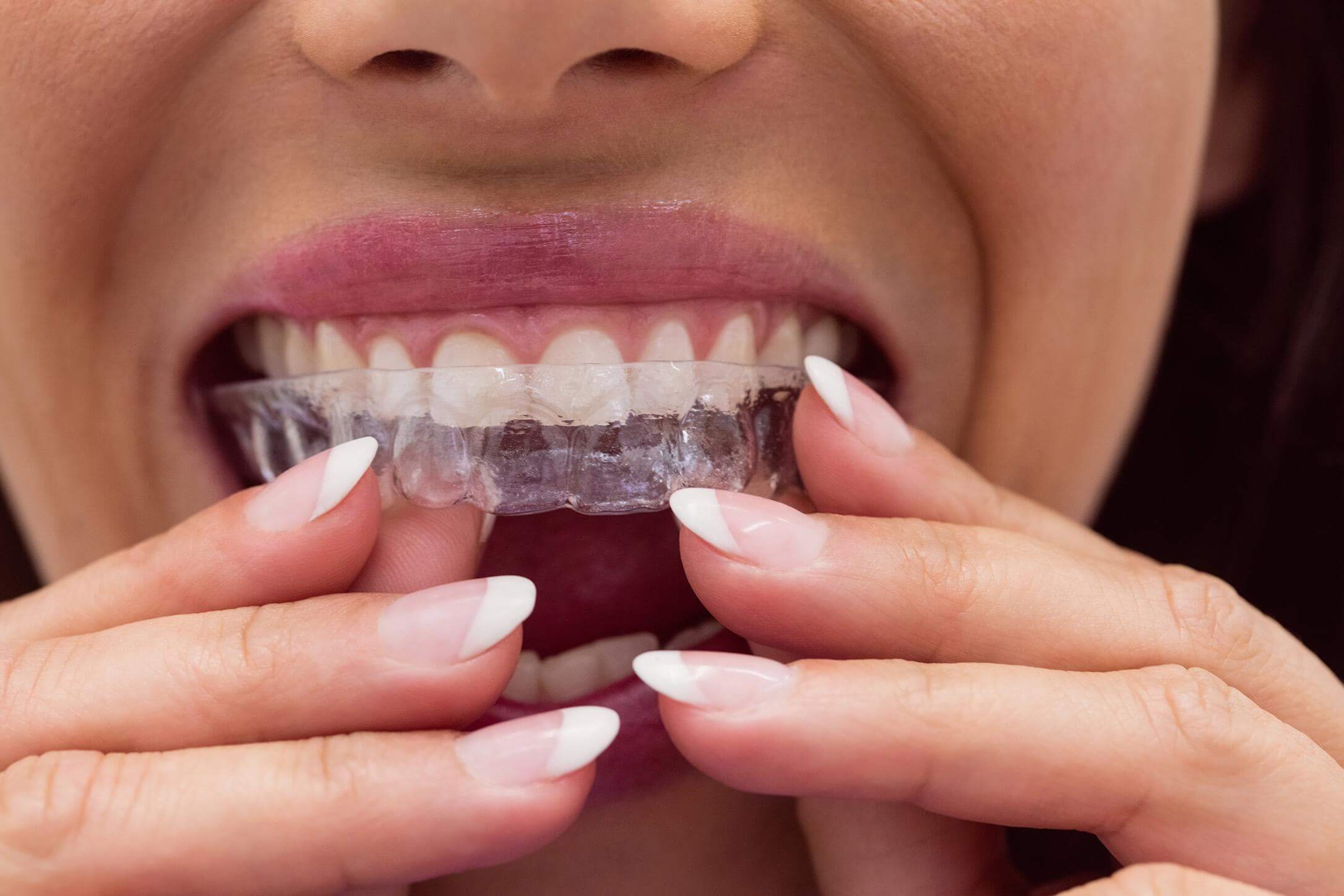 Invisalign - Studio Dentistico Dott. Spatafora Alessandro a bergamo